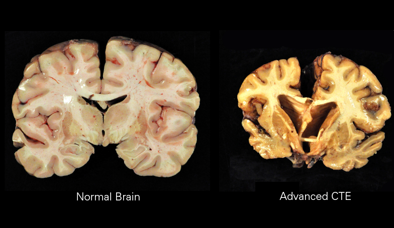 Chronic_Traumatic_Encephalopathy.png