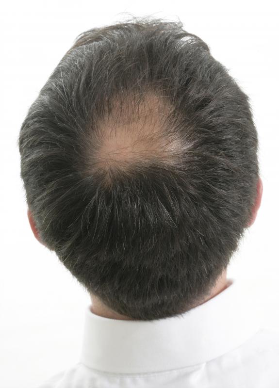 bald-spot.jpg